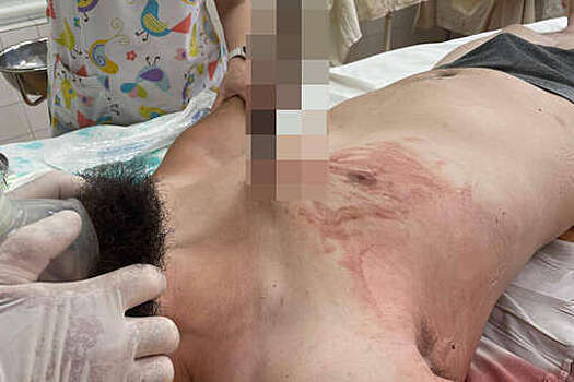 В Дагестане строителя, упавшего с высоты, насквозь пробило арматурой