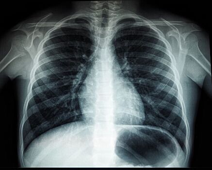 В Удмуртии за 11 месяцев выявлено почти 500 новых случаев рака лёгких