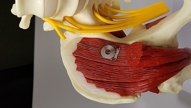 Новый биоразлагаемый имплантат ускорит восстановление повреждённых нервов