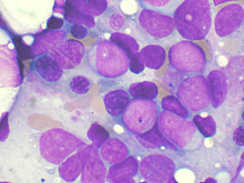 Блокировка рецептора IL-33 подавляет рост раковых клеток при остром миелоидном лейкозе