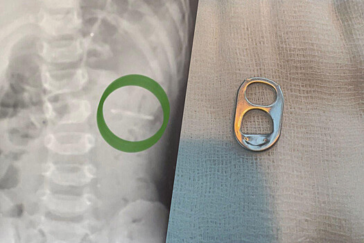 Врачи спасли мальчика, проглотившего ключ от металлической банки