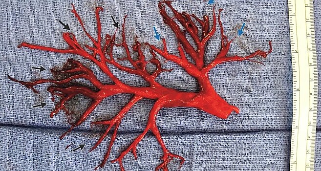 Плотный сгусток крови в форме бронхиального дерева: медицинская аномалия