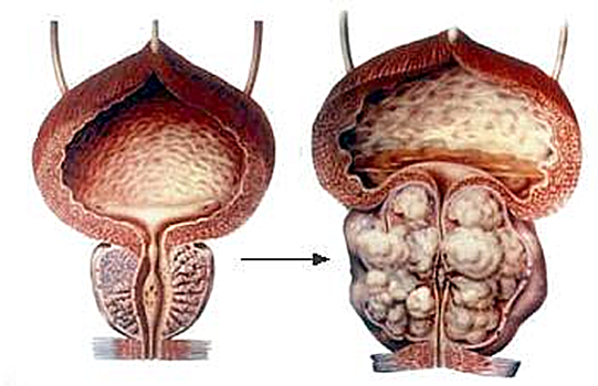 Гиперплазия простаты – нормальное явление для всех мужчин