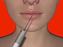 Опасны ли уколы ботокса