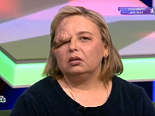 Пермячка на ТВ-шоу узнала о недуге, который изуродовал ее лицо