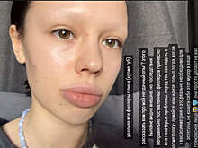 Рэперша Инстасамка рассказала, что ей кололи филлеры без лицензии