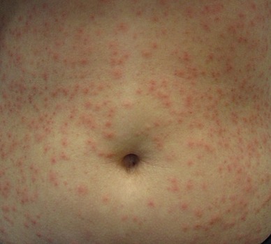 Синегнойная палочка: симптомы и лечение