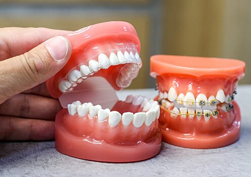 Стоматолог назвала лучшие способы исправить прикус
