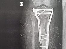 В Красногорскую больницу поступила женщина после падения с электросамоката