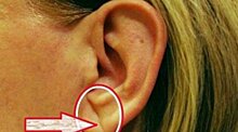 Риск инсульта можно определить по мочкам ушей