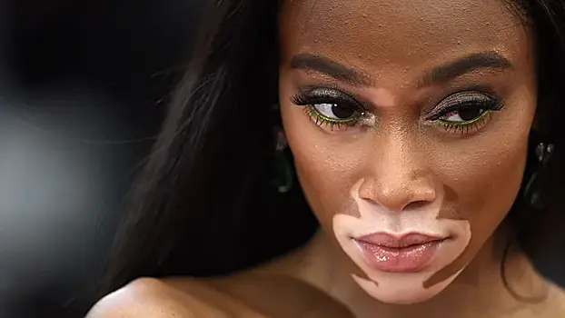 Названы причины развития витилиго