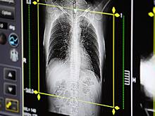 Врач назвала признаки развития пневмонии