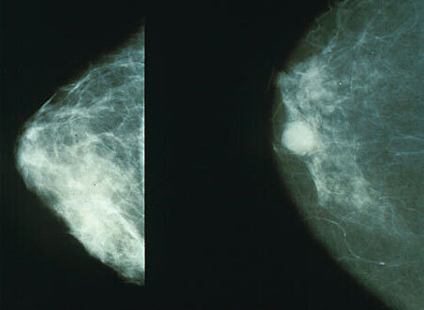 Запатентован 3D ультразвуковой томограф для диагностики рака молочной железы
