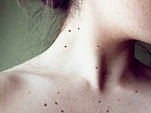 Жители района смогут принять участие в антимеланомной акции