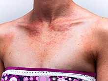 Врач раскрыла опасность кефира и сметаны для кожи