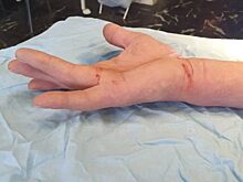 В ортопедическом отделении Красногорской больницы № 1 проводят лечение контрактуры Дюпюитрена без разрезов