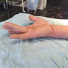 В ортопедическом отделении Красногорской больницы № 1 проводят лечение контрактуры Дюпюитрена без разрезов