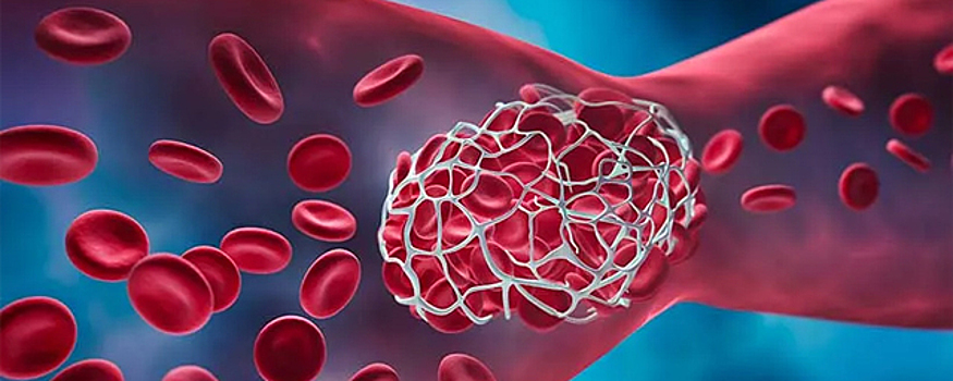 Терапевт: пациент может не подозревать о наличии тромба