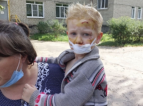 В Костромской области собака вцепилась в лицо 3-летнего ребёнка