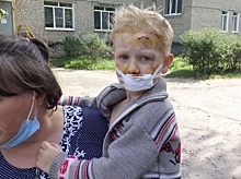 В Костромской области собака вцепилась в лицо 3-летнего ребёнка