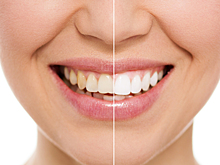 Россиянам рассказали о причинах желтизны зубов