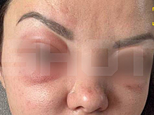 Россиянки стали чаще становиться жертвами уколов красоты