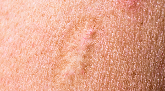 В России не выявлено ни одного случая заражения оспой обезьян