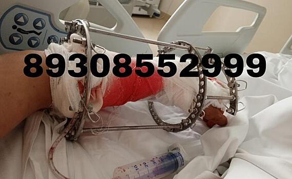 Курянину нужна финансовая помощь после тяжелой травмы руки