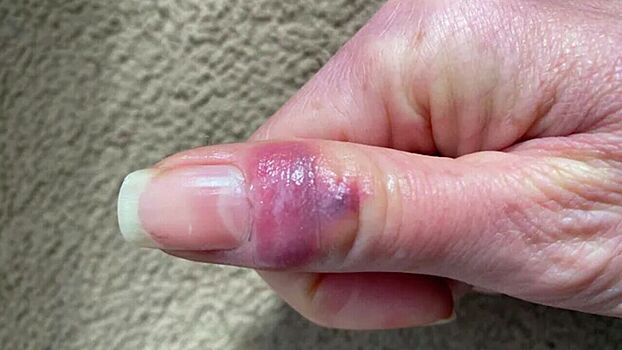 Врач рассказала, кому грозит симптом «ковидных пальцев»