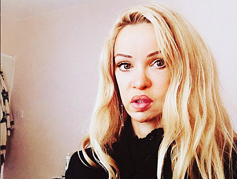 Из-за неудачной подтяжки лица модель пожизненно обречена на инъекции ботокса