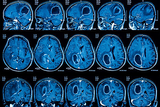 Пять важных фактов об опухолях головного мозга