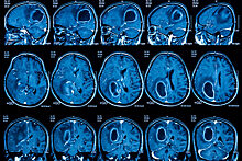 Пять важных фактов об опухолях головного мозга