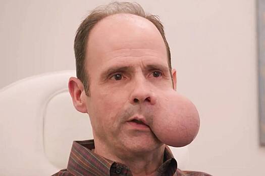 Мужчина вырастил на лице двухкилограммовую опухоль