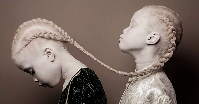 Близняшки-альбиносы: вероятность их рождения была 1:1 000 000