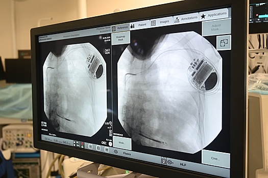 В Москве провели 18 бесплатных операций для людей с опасными формами аритмии