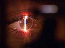 Можно ли до развития катаракты в старости заменить хрусталик