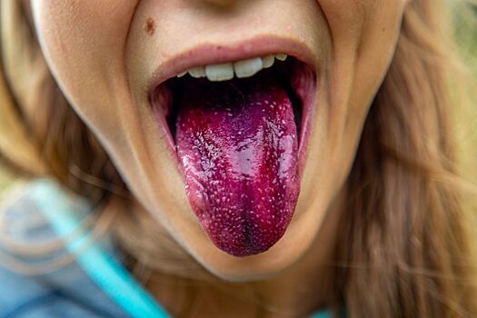 Онколог назвал симптомы рака языка