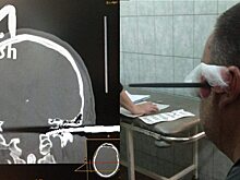 Саратовец пытался напильником «освободить» голоса в голове