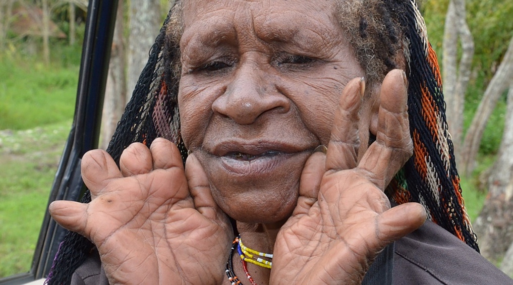 Лишние пальцы. Племя Дани (или Ндани) - коренные народы, населяющие плодородные земли  в Западном Папуа, Новая Гвинея. Каждый раз, когда в семье кто-то умирает, живые родственники отрезают себе пальцы и обмазывают лицо пеплом от сожжения тел умерших. Так они выражают свою скорбь. Пальцы, кстати, они хоронят вместе с родственниками.