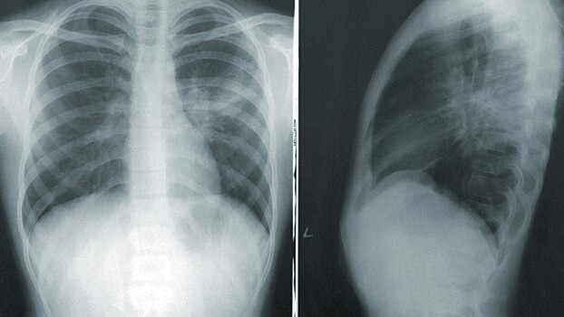 Как в России находят рак легкого на первых стадиях