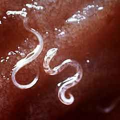 Личинки тропического паразита поселились в половом органе москвича