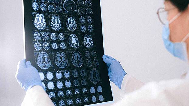 Иммунолог объяснил, как COVID-19 влияет на мозг