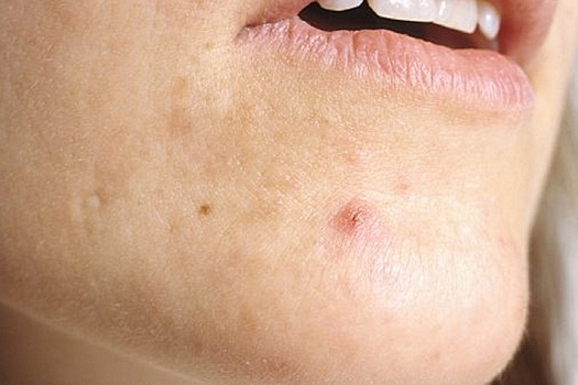 Врач Новиков: женское акне в зрелом возрасте вызвано нарушением работы яичников