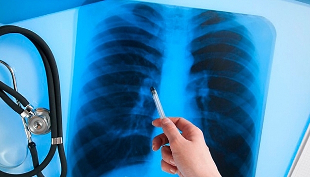 В больницы Сызрани попали пациенты с обостренной формой туберкулеза