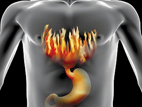 Кислотный рефлюкс может повысить риск рака головы и шеи у пожилых людей