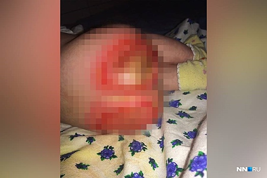 Медсестра больницы «Айболит», которая сожгла кожу младенца, пошла в «отказку»