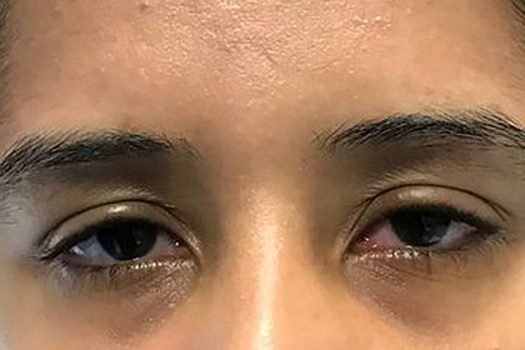 Жжение в глазах стало симптомом опасной болезни