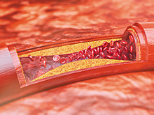 Причиной атеросклероза может быть ужесточение эритроцитов