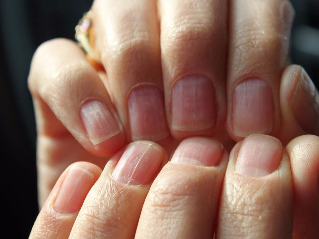 Почему на ногтях появляются продольные. Продольные борозды на ногтях. Продольные полосы на ногтях. Волнистые ногти педикюр. Волнистые ногти на больших пальцах рук.