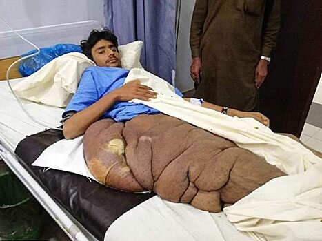 Хирурги вырезали с бедра подростка опухоль весом в 35 кг